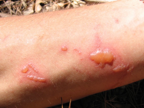 Close-up view of a person's arm showing a cluster of blisters and scars, indicative of a skin infection or reaction, set against a natural, outdoor background with dry grass and the subtle scent of